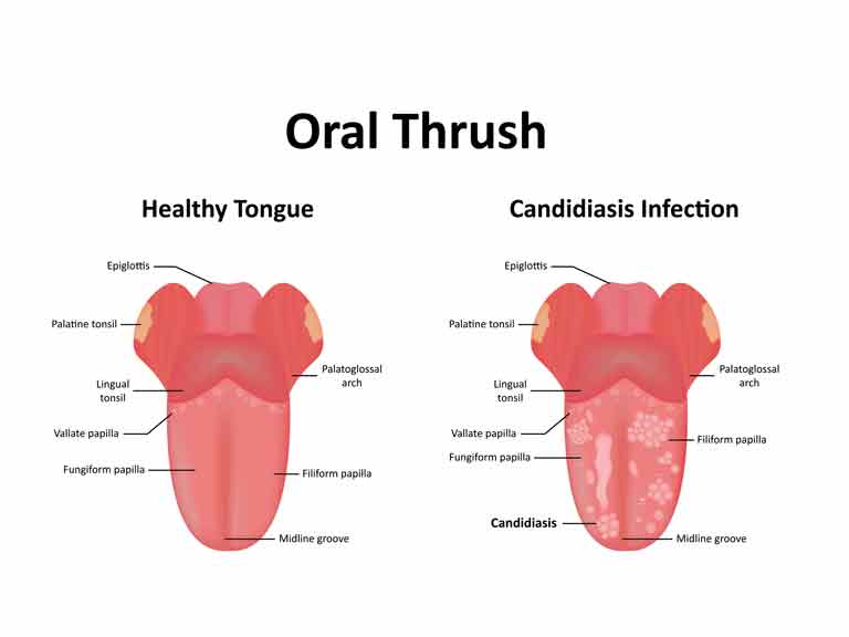 Oral thrush or candida