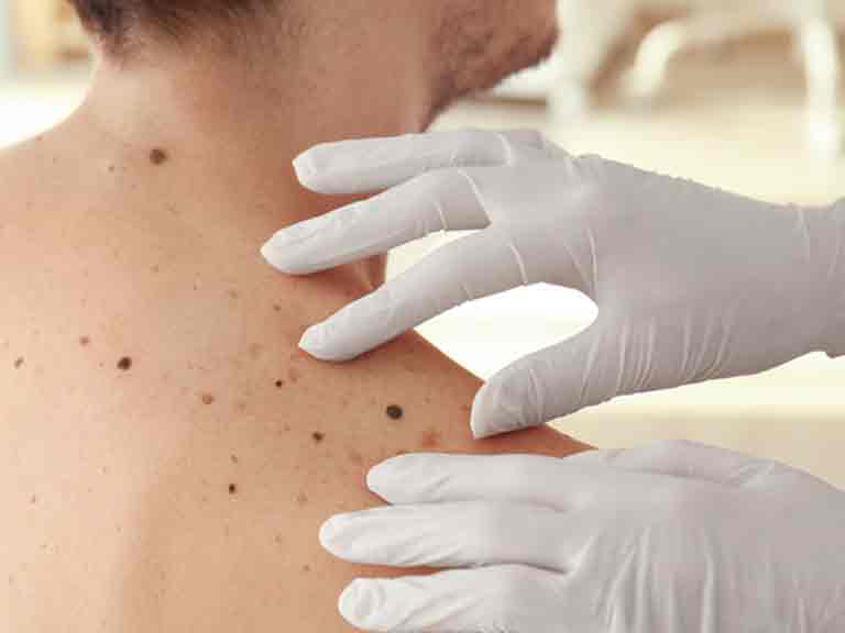 A dermatologist checks a patient's moles