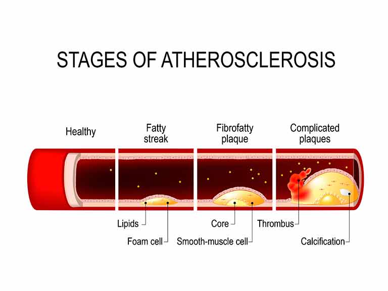 Average Cholesterol Levels By Age Chart