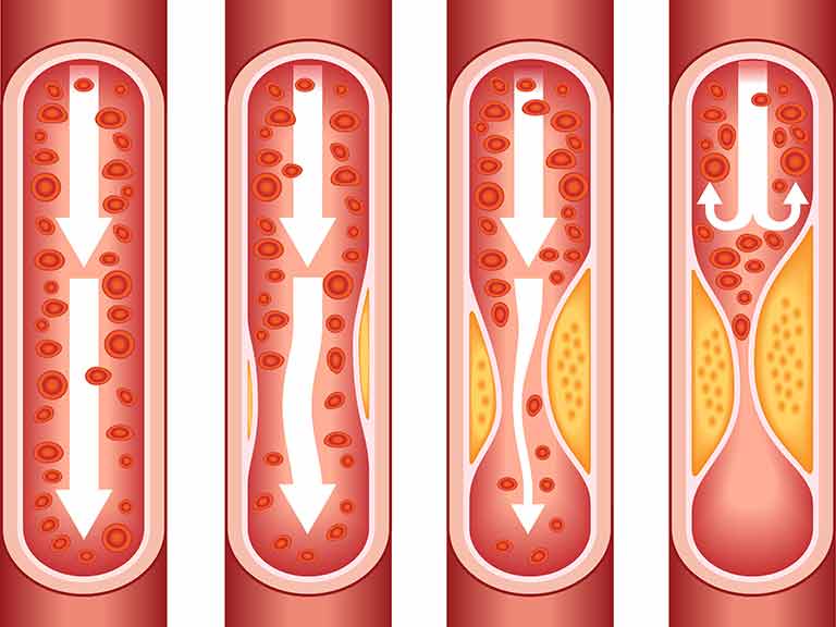 Atherosclerosis