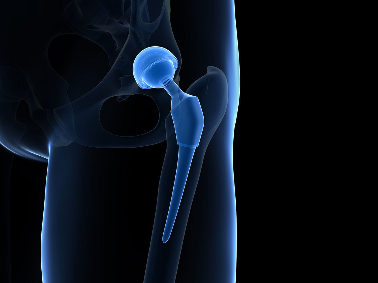 3D illustration of a hip replacement 