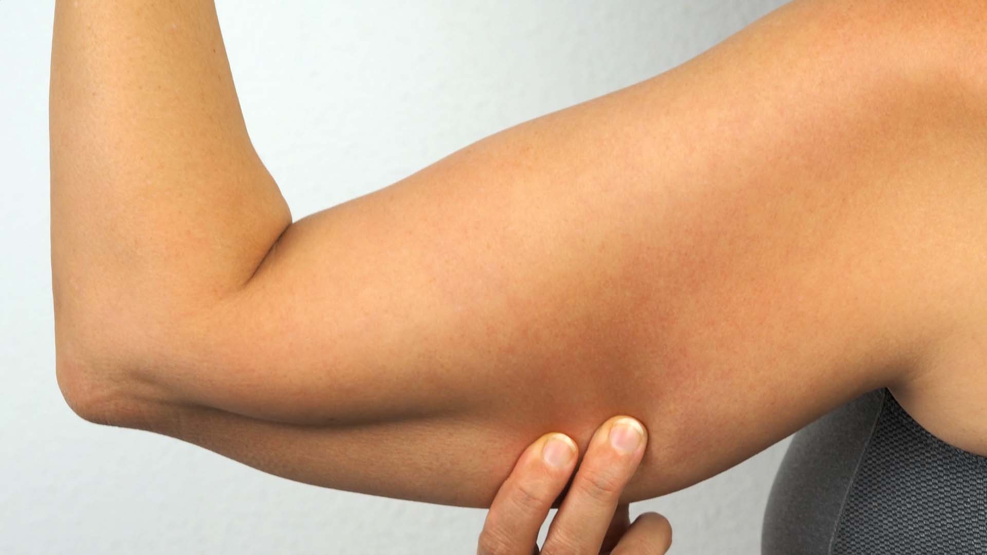 Woman pinching her triceps