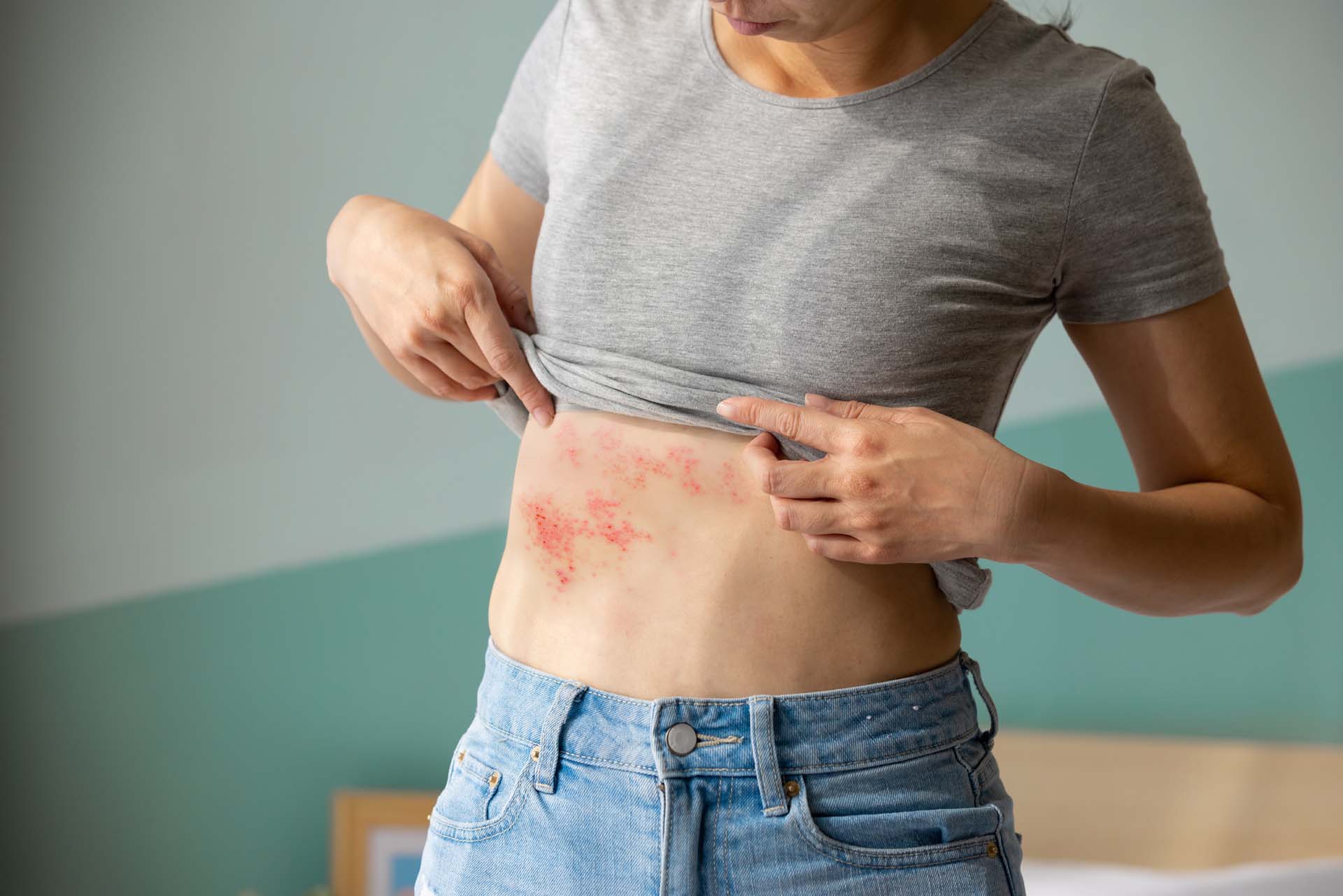 A person holds up their tshirt too reveal a rash on their tummy