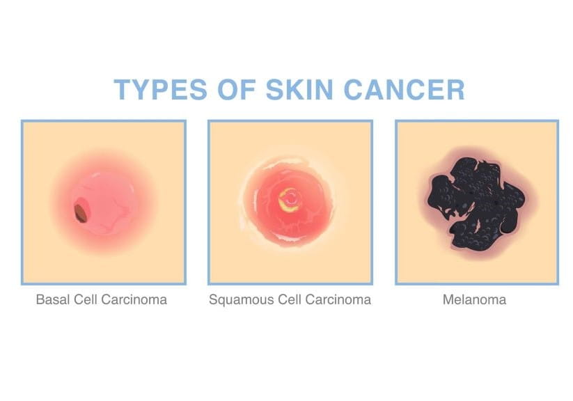 three different types of skin cancer