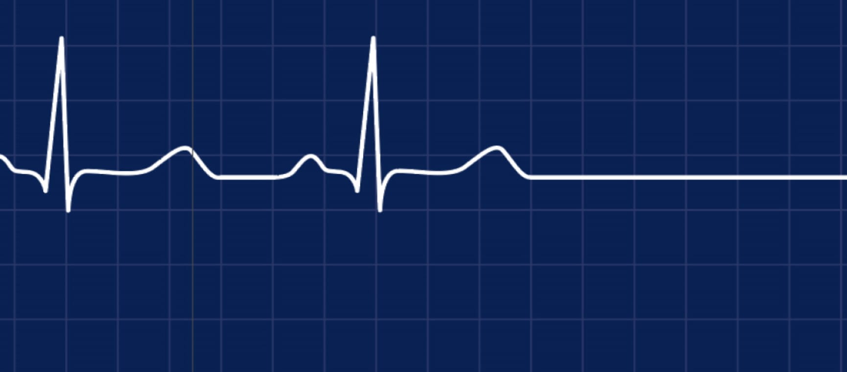 A heartbeat line stopping to represent assisted dying | Saga