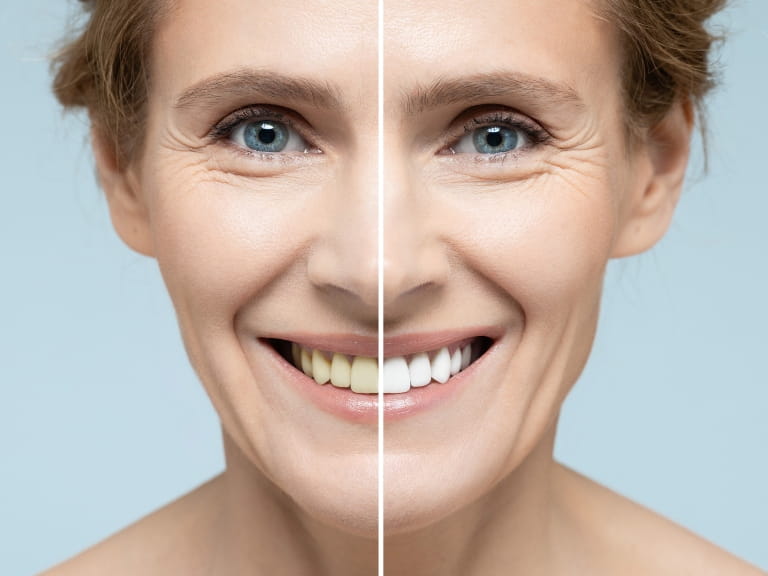 A before and after photo of a mature woman following a teeth whitening procedure