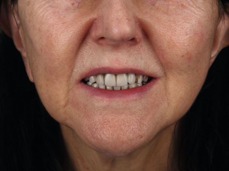 Liz Jones teeth before