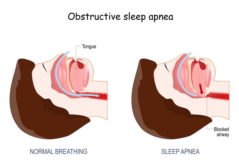 An anatomical diagram of obstructive sleep apnea