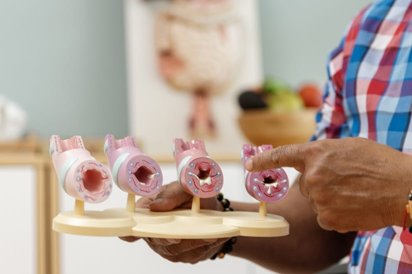 Dr holding models of arteries with varying levels of cholesterol
