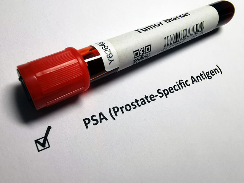 The Prostate-Specific Antigen test