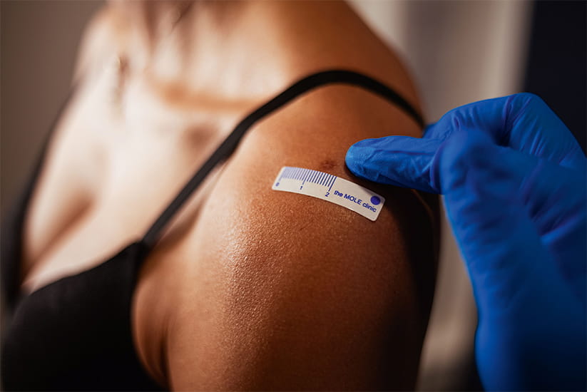 A measuring sticker next to a mole being examined